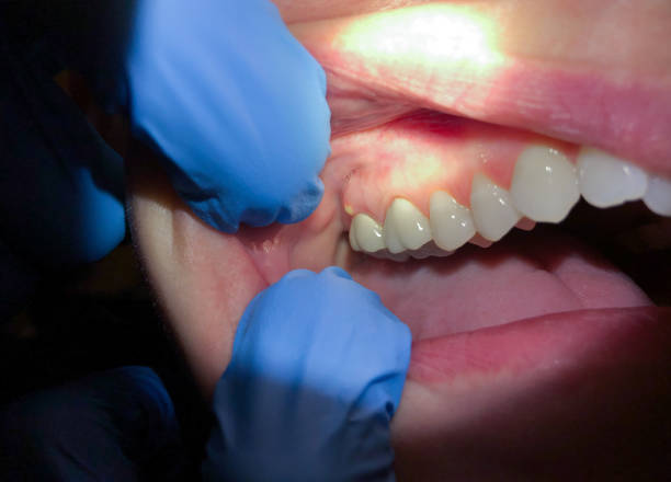 Best Emergency Dental Care for Broken or Chipped Teeth in Huntington Station, NY